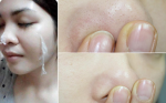 Sạch mụn cám từ trong ra ngoài bằng cách đơn giản