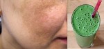 Trị Nám Siêu Tốc Hiệu Quả Sau 7 Ngày chỉ với Một Nắm Lá