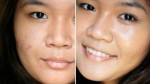 Hỗn hợp rẻ tiền giúp đánh bay vết thâm mụn chỉ sau 2 tuần