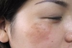 Thực phẩm là "khắc tinh" của nám, tàn nhang