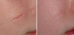 Sẹo lâu năm chỉ cần dùng hỗn hợp này sẽ khỏi