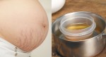 Trị bay rạn da cho mẹ bầu chỉ với 2 nguyên liệu cực dễ tìm