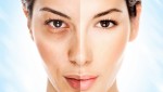 Mẹo trị nám hiệu quả bằng phương pháp đơn giản
