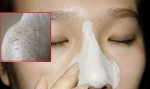 Chia sẻ cách giúp chị em không lo lỗ chân lông to khi lột mụn