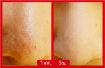 1 phút đánh bay mụn đầu đen trên mũi với thứ ai cũng dùng hàng ngày