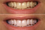 3 công thức thiên nhiên giúp hàm răng luôn trắng sứ